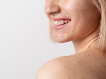 como disminuir cicatrices y marcas de acne