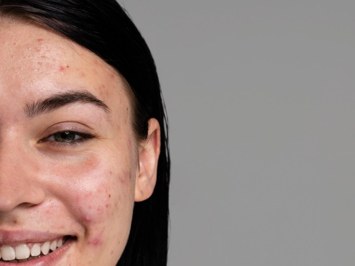 ruitina de skin care si tienes rosacea
