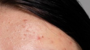 ruitina de skin care si tienes rosacea