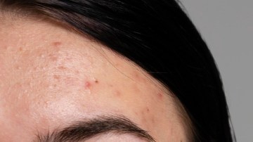 ruitina de skin care si tienes rosacea