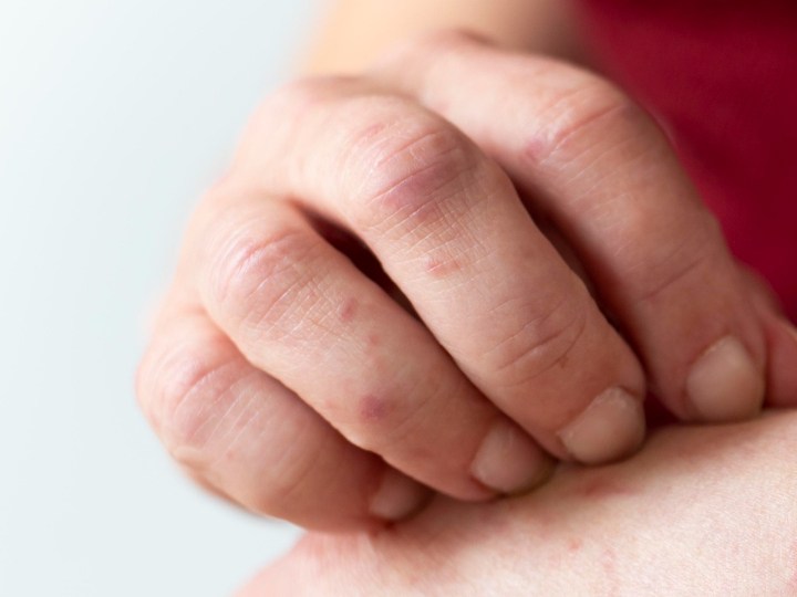 afecciones de la piel mas comunes