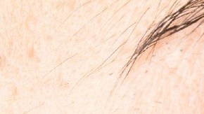 causas de las ojeras y bolsas en los ojos