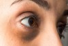 causas de las ojeras y bolsas en los ojos