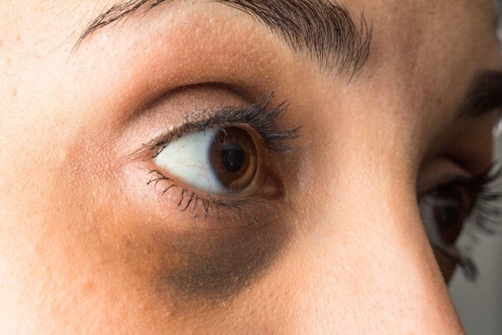 causas de las ojeras y bolsas en los ojos