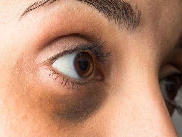 causas de las ojeras y bolsas en los ojos