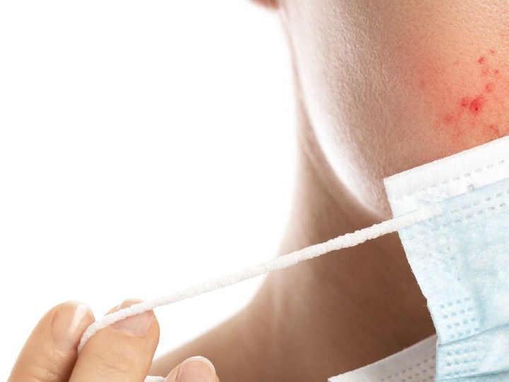 como prevenir acne causado por mascarilla