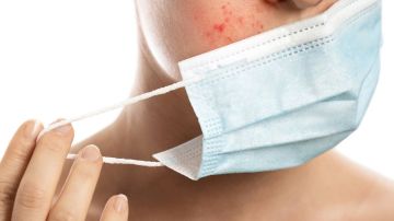 como prevenir acne causado por mascarilla