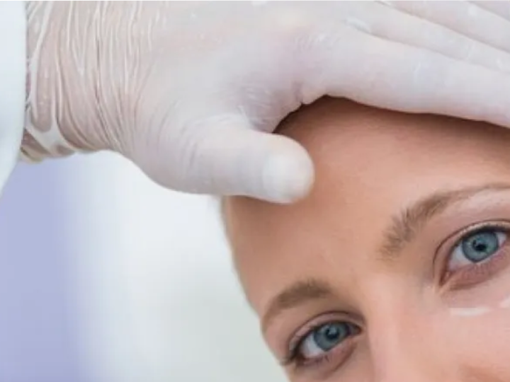 fillers para desaparecer ojeras