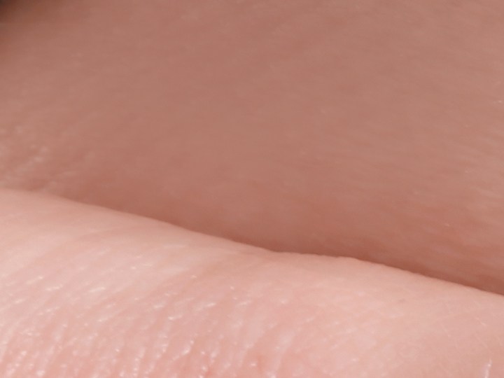 Celulitis