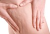 Celulitis