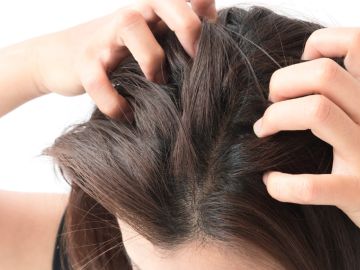 en pelo: 5 tratamientos para calmarla y sanar el cuero cabelludo con caspa - Bien Bonita