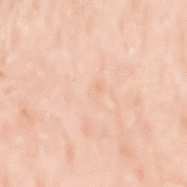 Caspa en las cejas