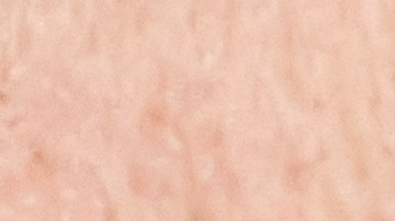 Caspa en las cejas