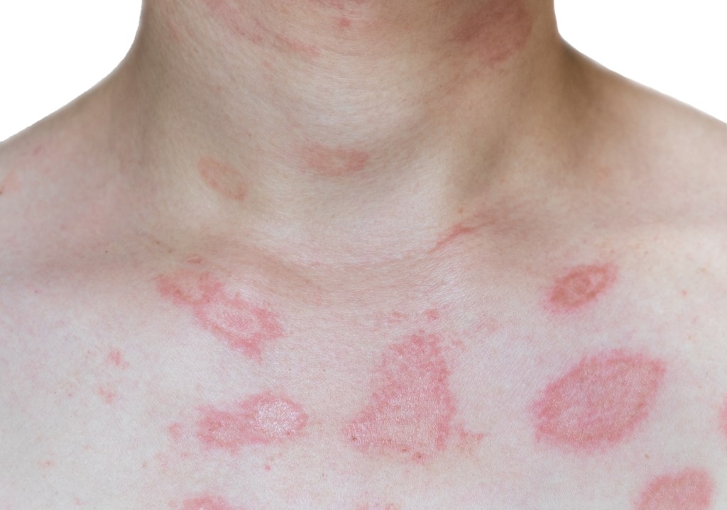 Urticaria