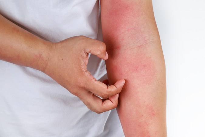 Eczema
