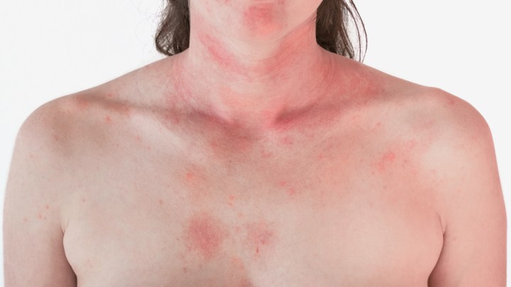 Eczema