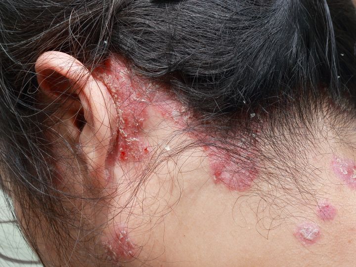 Psoriasis