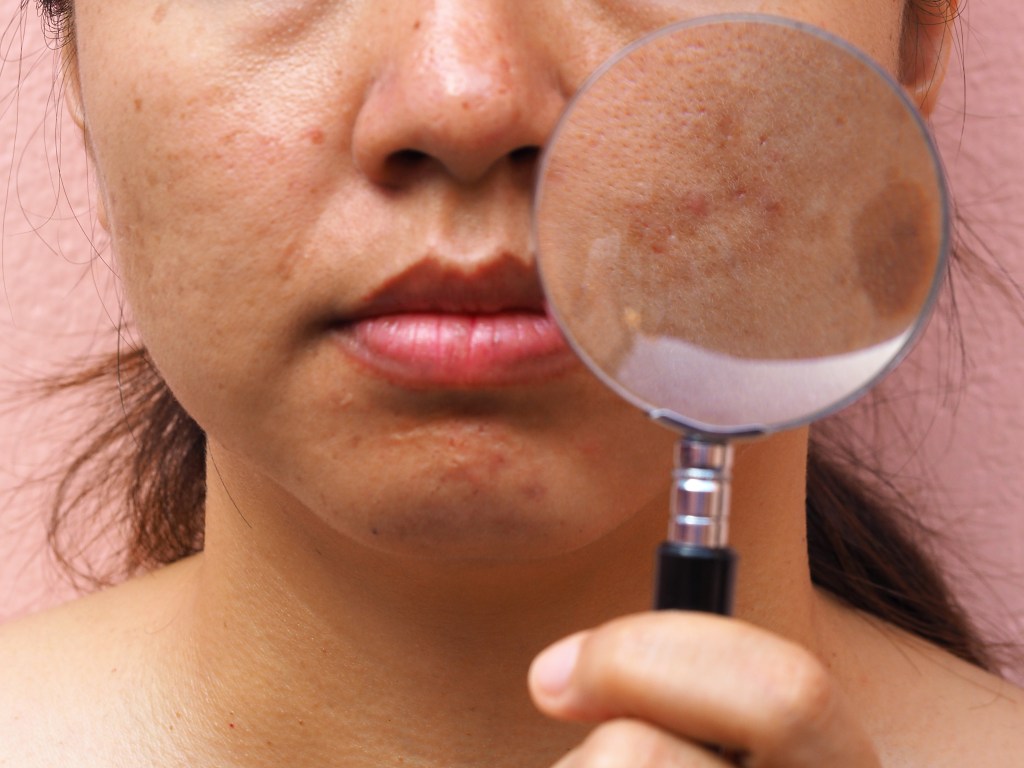 Melasma