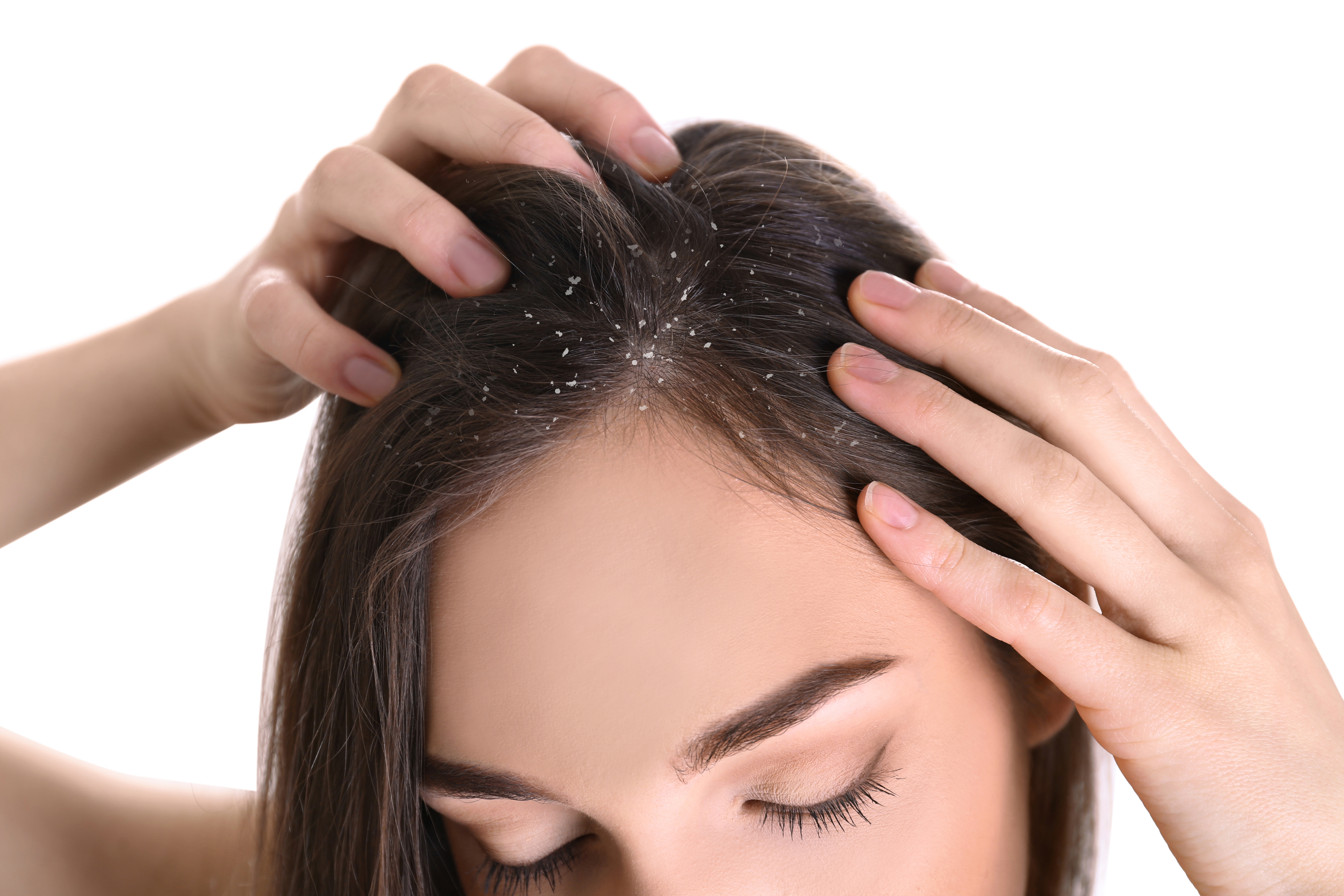 Caaspa Cómo preparar un tónico casero para combatir la caspa en el cabello ...