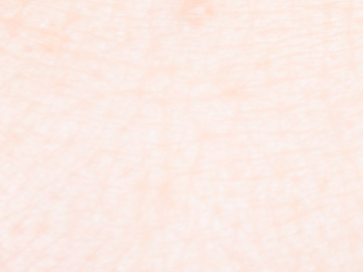 Bolsas debajo de los ojos