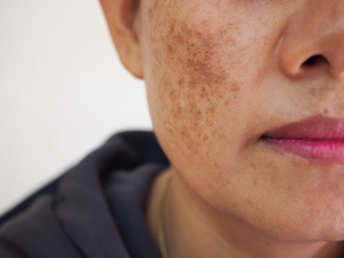 Melasma