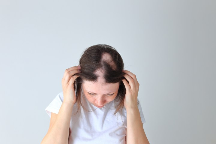 Alopecia