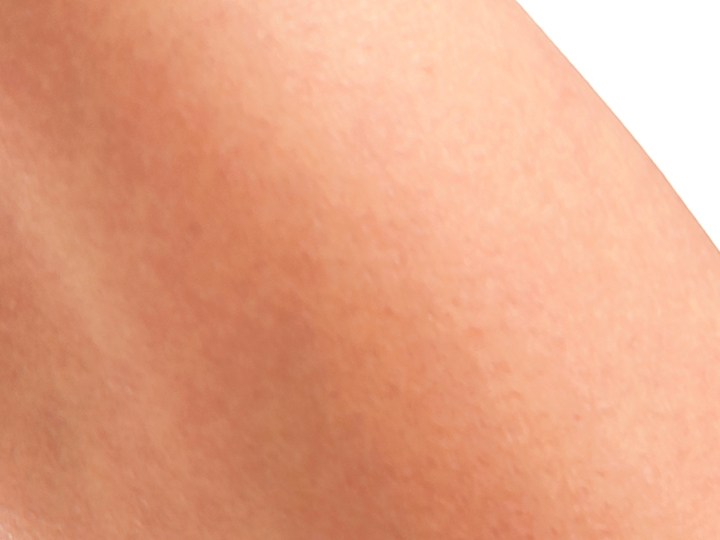 Celulitis