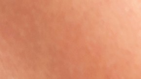 Celulitis