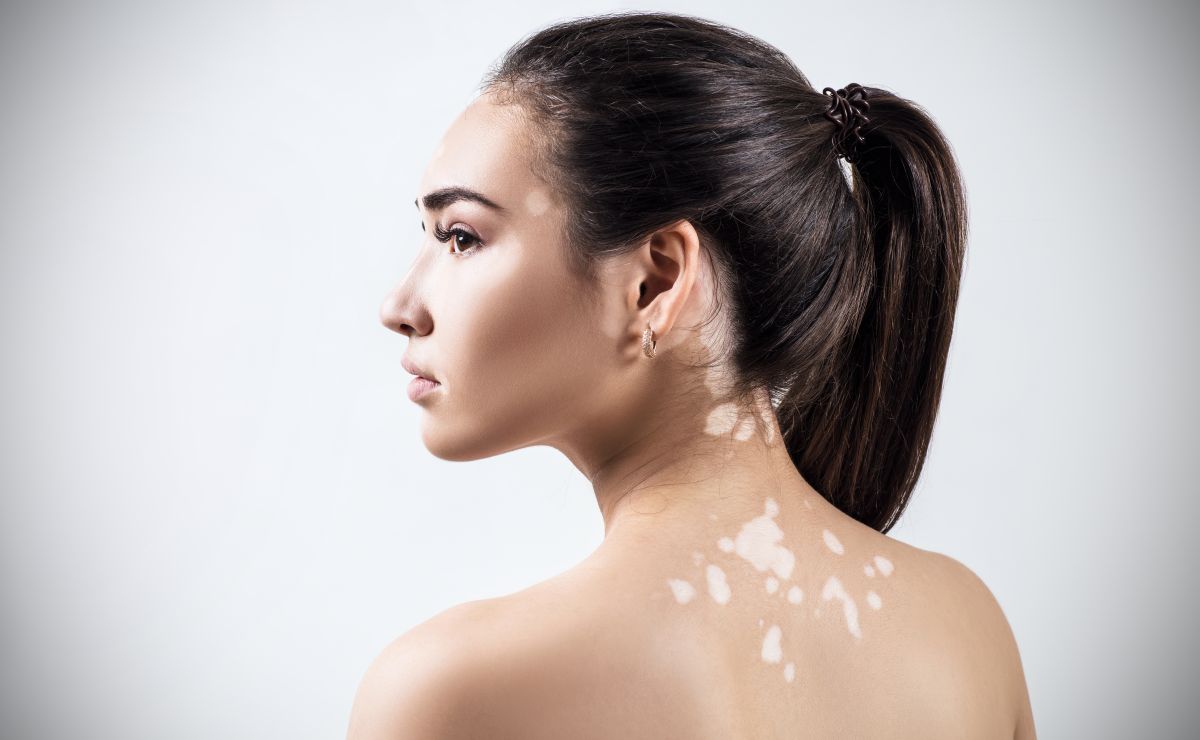 Vitiligo Skin Caused by the Sun: How to Prevent It in Time