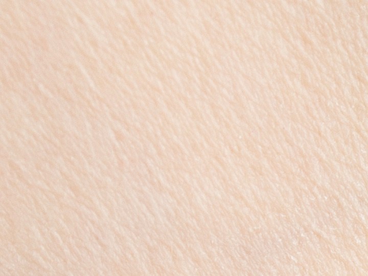 Foliculitis