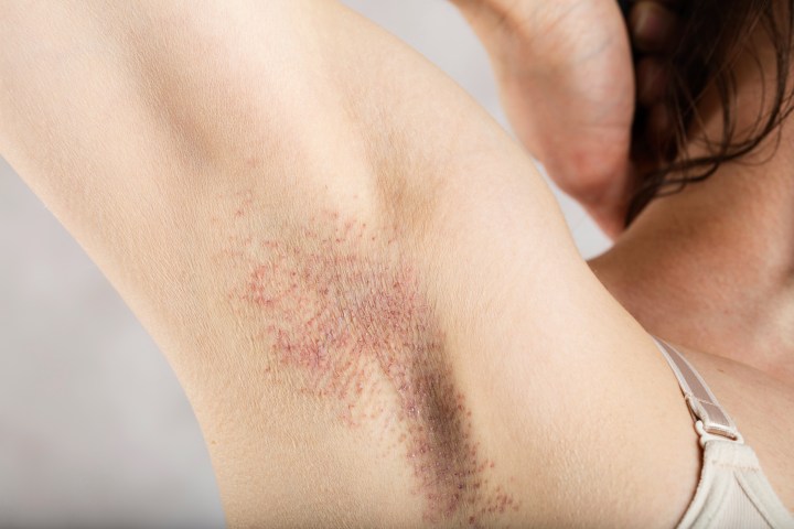 Foliculitis