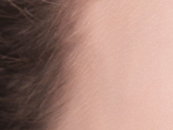 rejuvenecimiento facial con cirugía