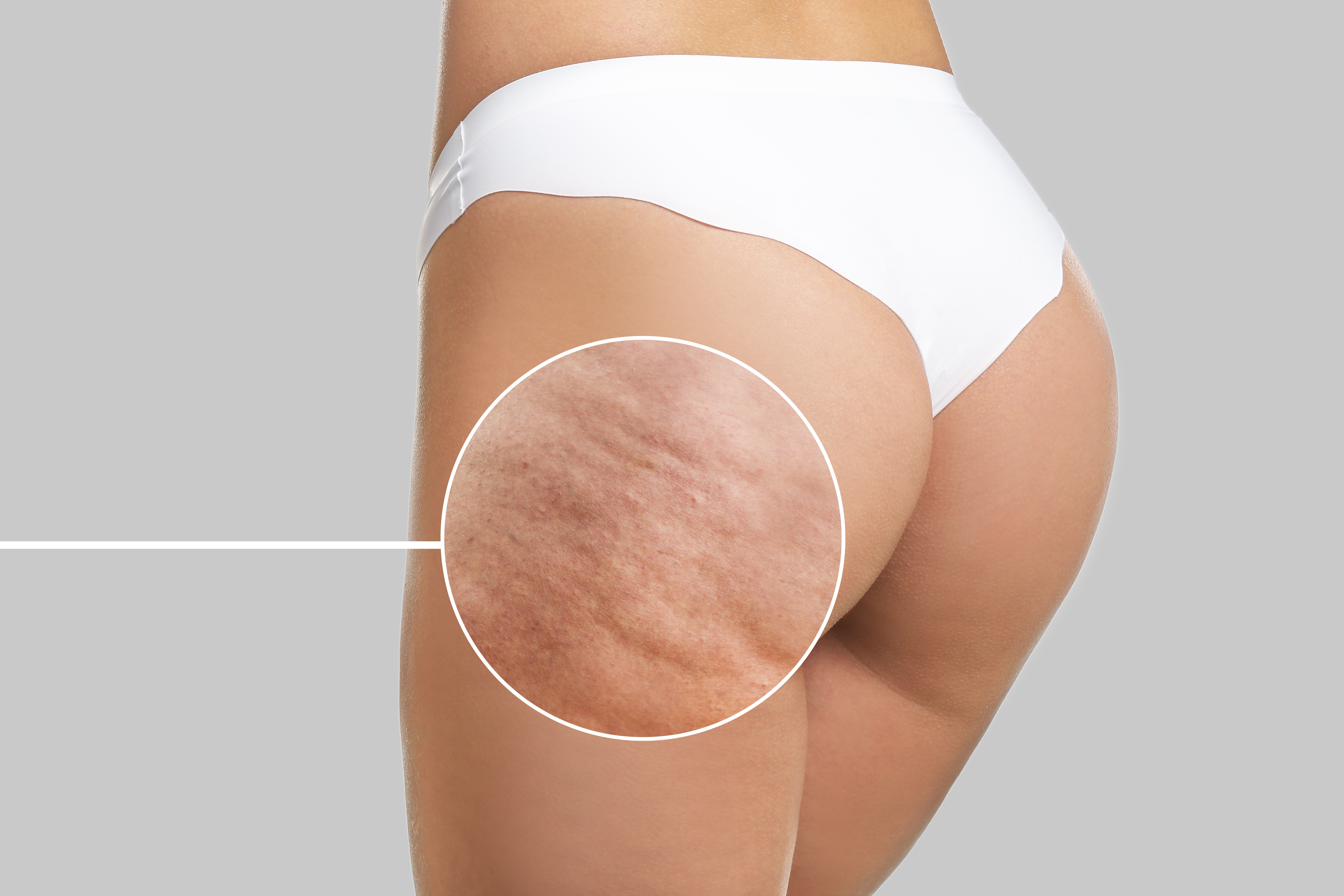 Reduce las celulitis con los tratamiento adecuados para su cuidado.