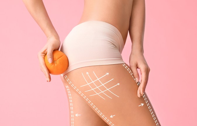 Cuida tu piel con los procedimientos adecuados para evitar las celulitis.