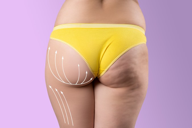 Realiza ejercicios y mantén una buena alimentación para evitar las celulitis.