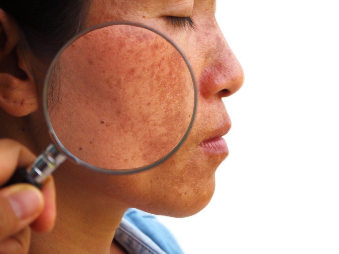 El melasma genera manchas marrones en la piel.