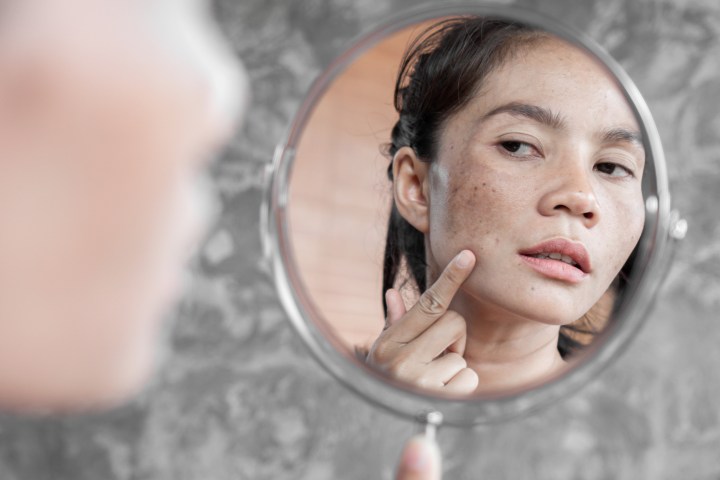 La arbutina es uno de los mejores componentes para reducir la melasma.