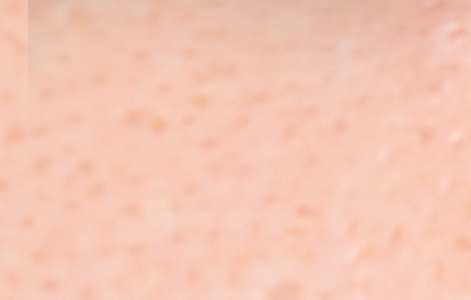 La rosácea puede alterarse con mucha facilidad y causar enrojecimientos.