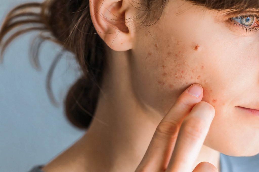 Las manchas en la piel pueden aparecer por brotes de acné o la exposición a rayos solares.