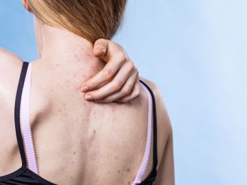El acné en la espalda puede tratarse con una buena higiene.