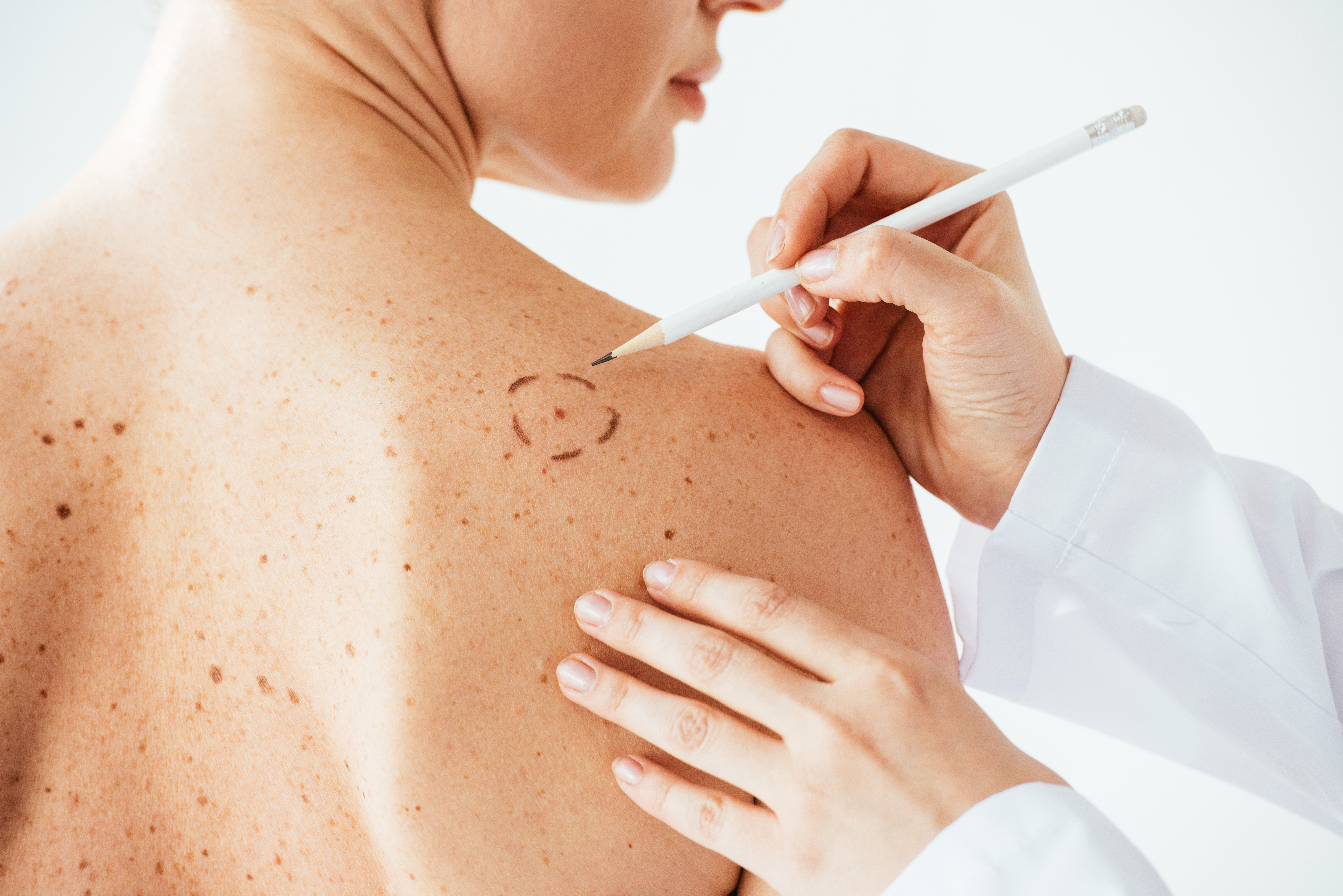 El melanoma puede aparecer en cualquier zona del cuerpo.