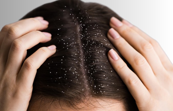 Limpia tu cuero cabelludo con los productos adecuados para evitar la caspa.