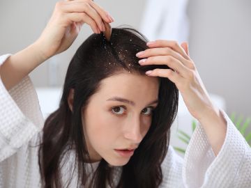 Evita la caspa en tu cabello al prevenir los factores que la desencadenan.