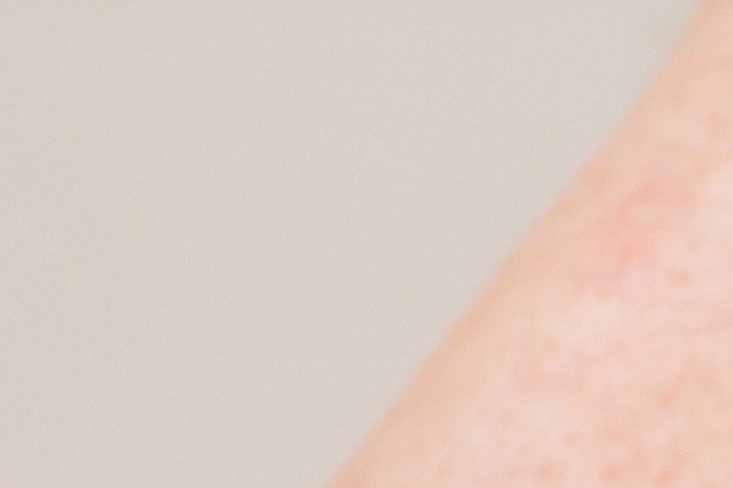 Usa el tratamiento indicado por un especialista para la rosácea.