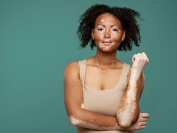 El vitíligo es una de las enfermedades de la piel menos conocidas.