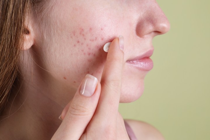 Prepara tu piel con acné antes del maquillaje con el nuevo producto de Sheglam.