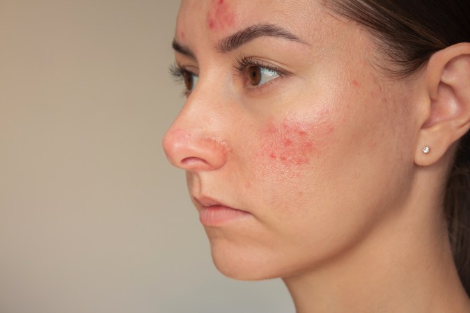 Una mala alimentación puede promover la aparición de brotes de acné.