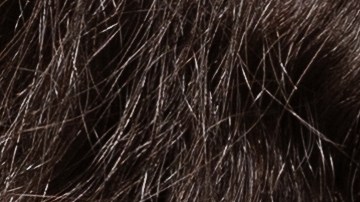 La dermatitis atópica debe cuidarse con una rutina adecuada.