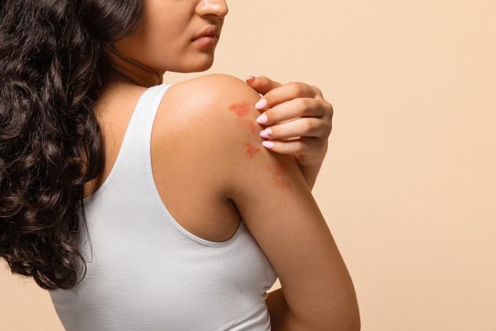 La dermatitis atópica debe cuidarse con una rutina adecuada.