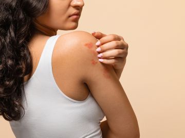 La dermatitis atópica debe cuidarse con una rutina adecuada.
